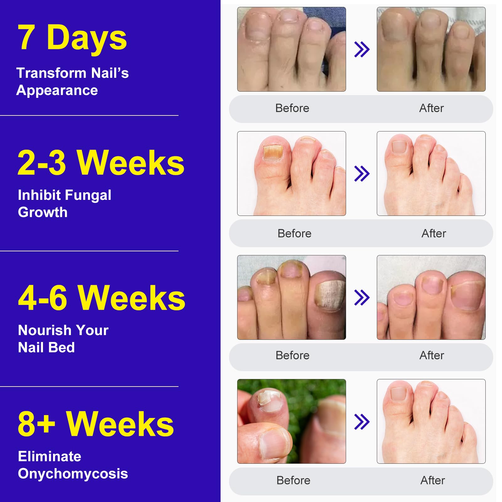 Toenail Treatment Extra Strength - 24 Pcs Nighttime Nail Patches, Overnight Toe Nail Treatments for Damaged Nails Foot Nails Repair and Care