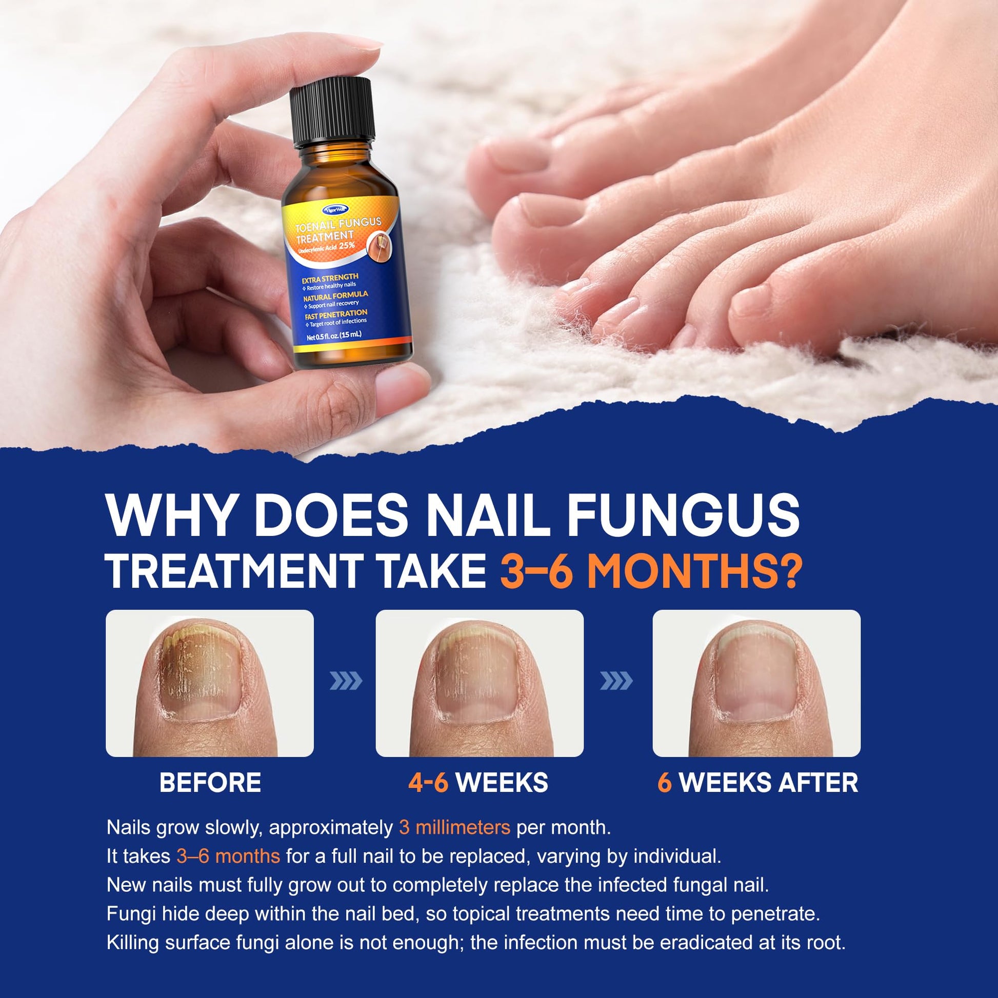 Toenail Fungus Treatment with 25% Undecylenic Acid: Toenail Fungus Treatment Extra Strength for Thick, Yellow and Damaged Nails - Safe and Gentle for Nails Care